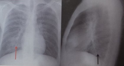 Pneumonia interstițială sau atipică pe radiografia toracică