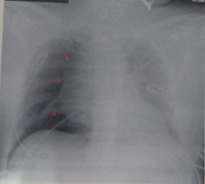 Patologia pleurală pe radiografia toracică