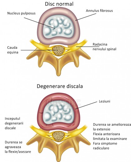 Boala de disc degenerativa