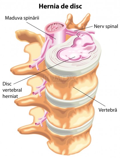 Hernie de disc