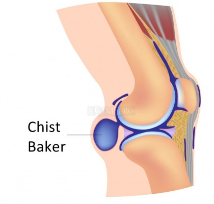 Chist Baker (chist popliteal)