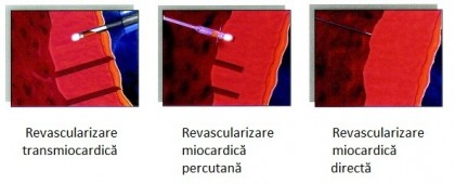 Revascularizarea miocardică