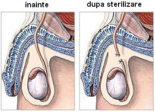 Vasectomia - sterilizarea masculina