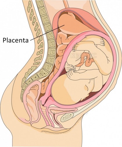 Placenta praevia