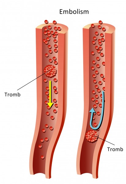 Boala tromboembolica puerperala