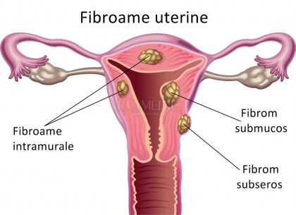 Fibromul uterin si sarcina