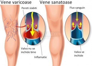 varicoza crioterapiei)