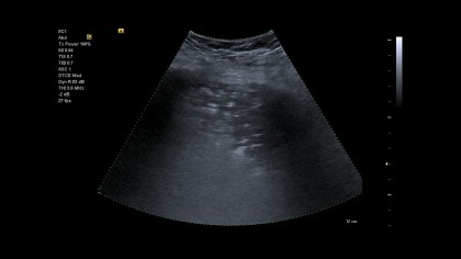 Ecografia la pacientii cu COVID-19