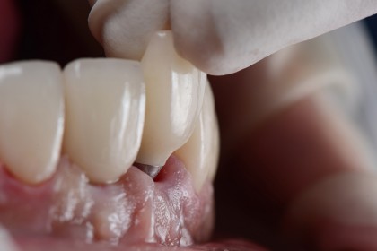 Implantul dentar marca Dentetico, soluția perfectă pentru dinții lipsă. Cum lucrăm noi