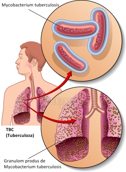 Tuberculoza pulmonara - TBC