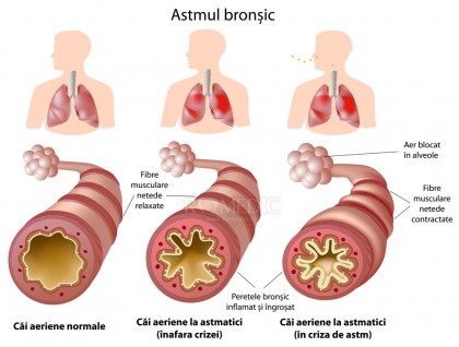 Ghidul pacientului astmatic