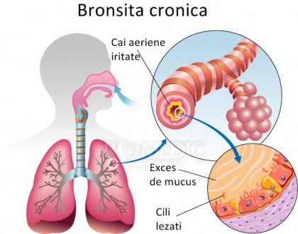 Bronșita cronică