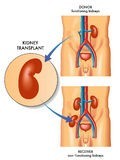 Infectii dupa transplant de organ parenchimatos