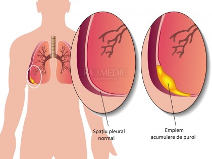 Pleurezia purulenta - Empiem pleural