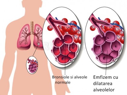 Emfizemul interstitial pulmonar