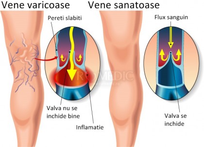 nu în vene varicoase