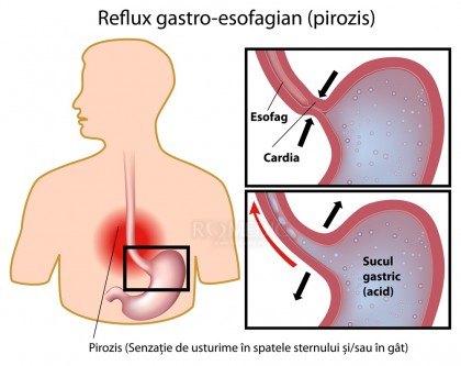 Arsurile la stomac