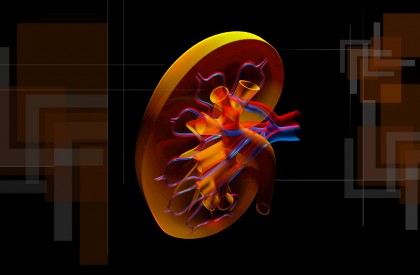 Pietrele la rinichi ar putea crește riscul de AVC și boli coronariene