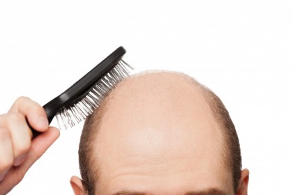 Alopecie androgenica
