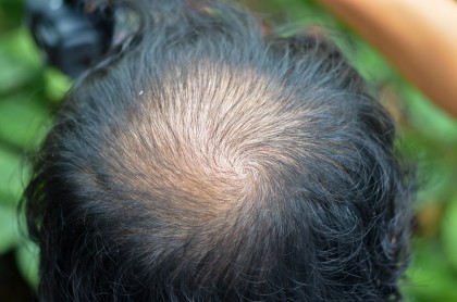 Alopecia areata