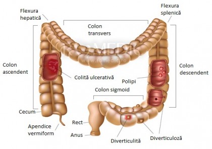 Localizarea tumorii primare poate prezice supraviețuirea în cazul cancerului de colon