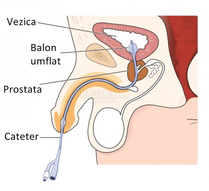 Cateterism uretral/ sonda vezicala