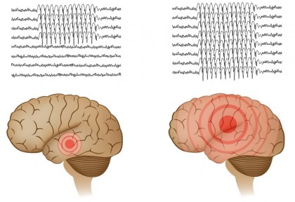 O nouă tehnică pentru tratamentul chirurgical al epilepsiei