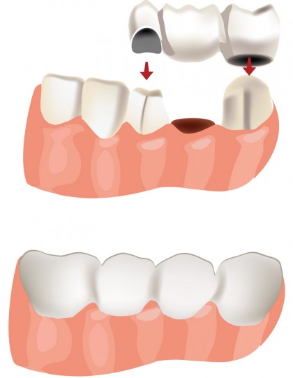 Ce soluții există pentru dinții lipsă?