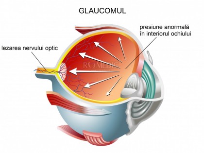 Numărul de cazuri de orbire din cauza glaucomului a crescut îngrijorător