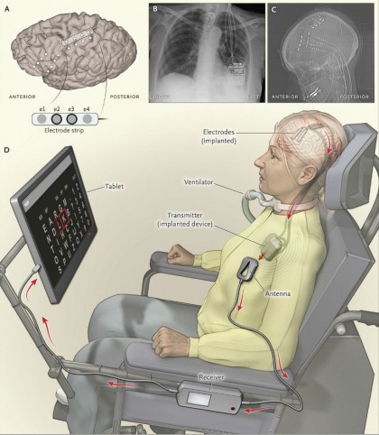 Un implant unic le permite bolnavilor de scleroză laterală amiotrofică (ASL) să comunice