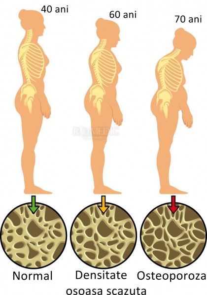 Factori de risc pentru osteoporoză