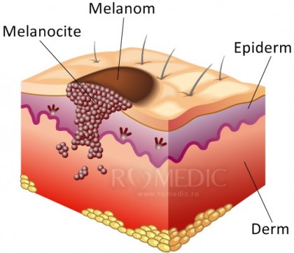 Un nou medicament ar putea reduce răspândirea melanomului cu până la 90%