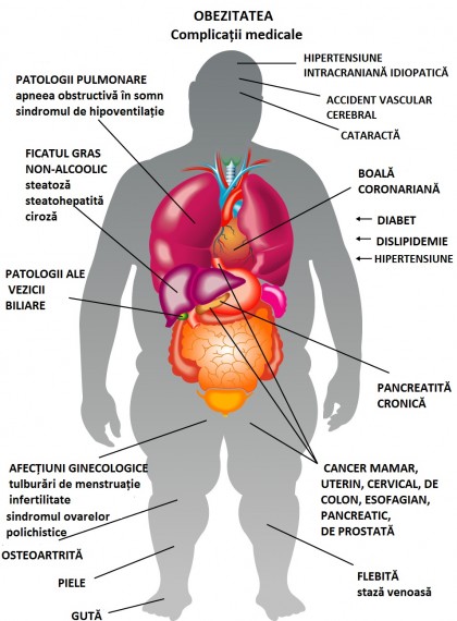 „Obezul metabolic sănătos”, mit sau realitate?