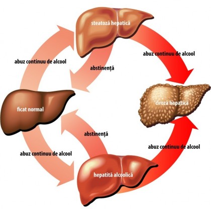 Hepatita alcoolica