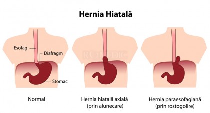 Hernia hiatala