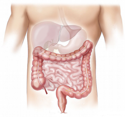 Ce trebuie să știi despre screening-ul cancerului colorectal?