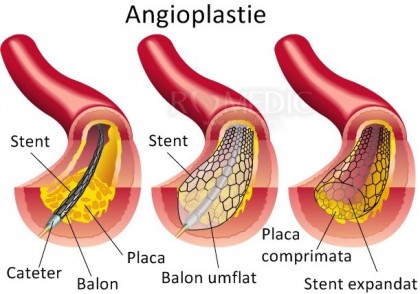 Când e indicată angioplastia cu stent?