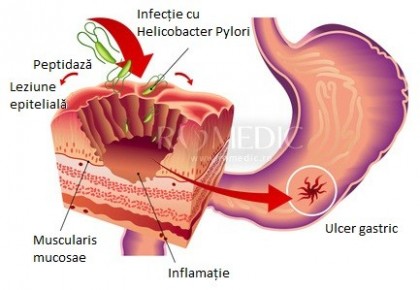 Ulcerul gastric si duodenal