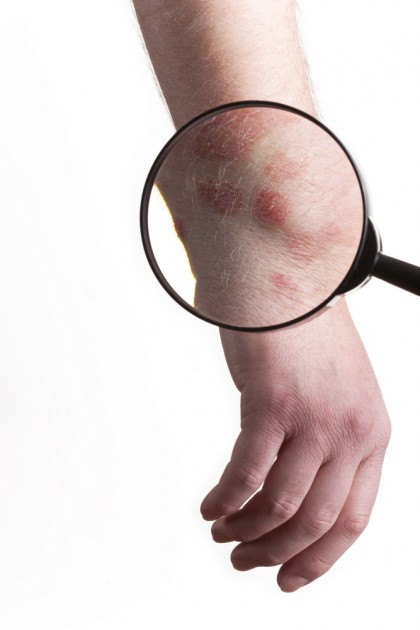 O nouă abordare în tratamentul eczemei