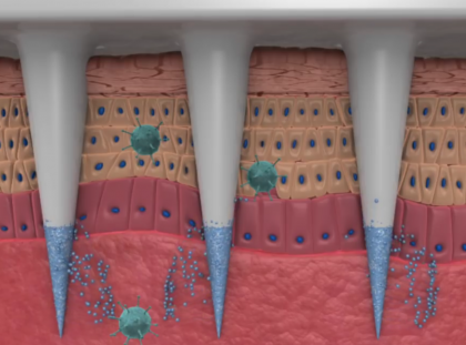 Microace ce se dizolvă în piele și eliberează medicamentul