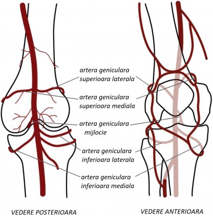 Embolizarea arterelor geniculare (GAE) - operația pentru osteoartrita genunchiului ce poate diminua durerea