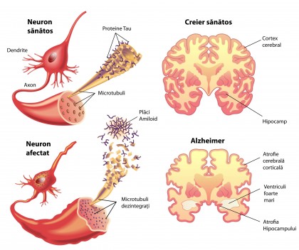 Anticorpi ce îndepărtează plăcile de amiloid din Alzheimer la modele animale