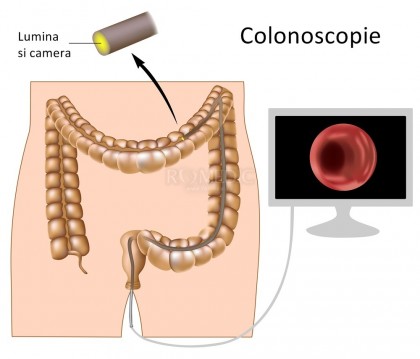 Colonoscopia