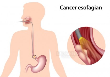 Cancerul esofagian