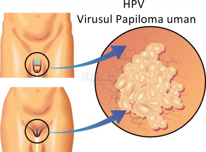 papiloma a dispărut ce să facă