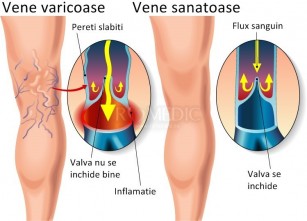 terapia de presă la picior în varicoză