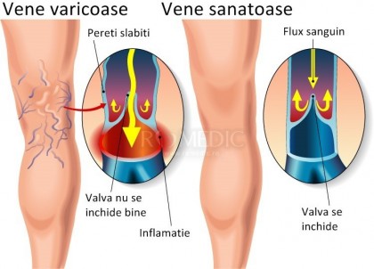 vene varicoase ceea ce este