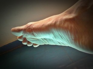 Hallux rigidus - Artroza. Cauze si tratament.