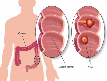 Diagnosticul de polip colon - ce trebuie să știi