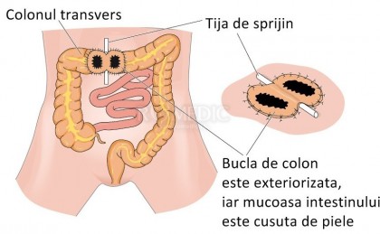 Viața cu anus contra naturii (ce reprezintă, îngrijire, complicații posibile)